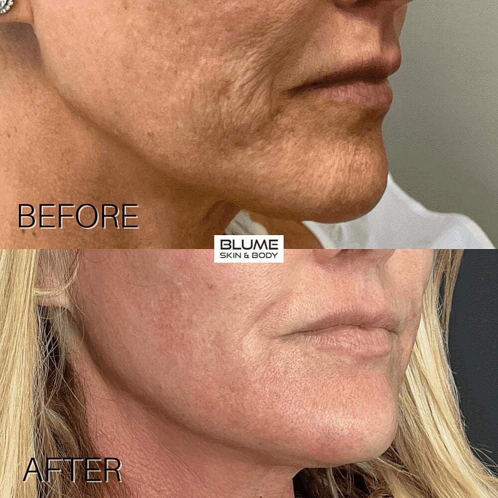 Laser Skin Treatments Before & After