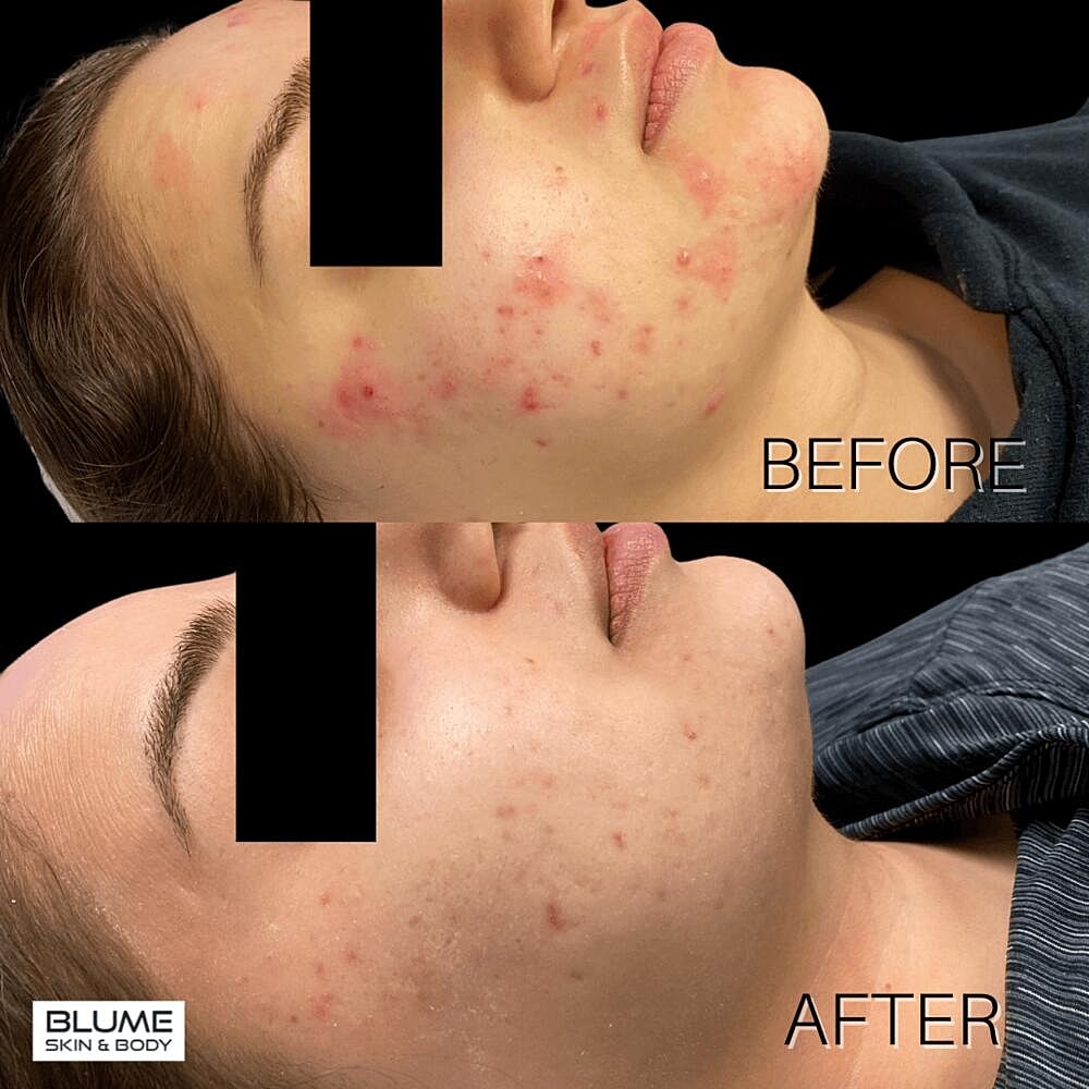 Laser Skin Treatments Before & After