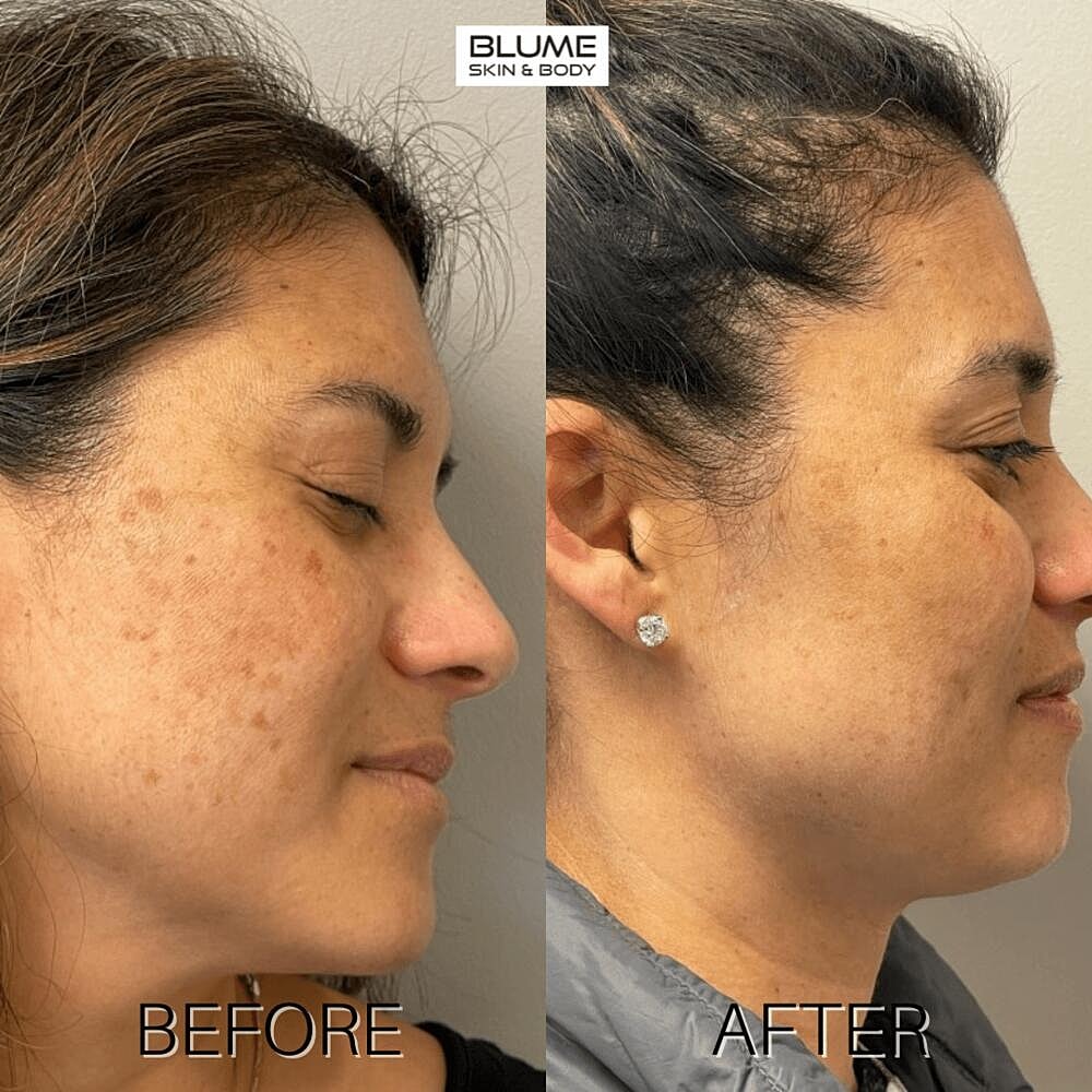 Laser Skin Treatments Before & After