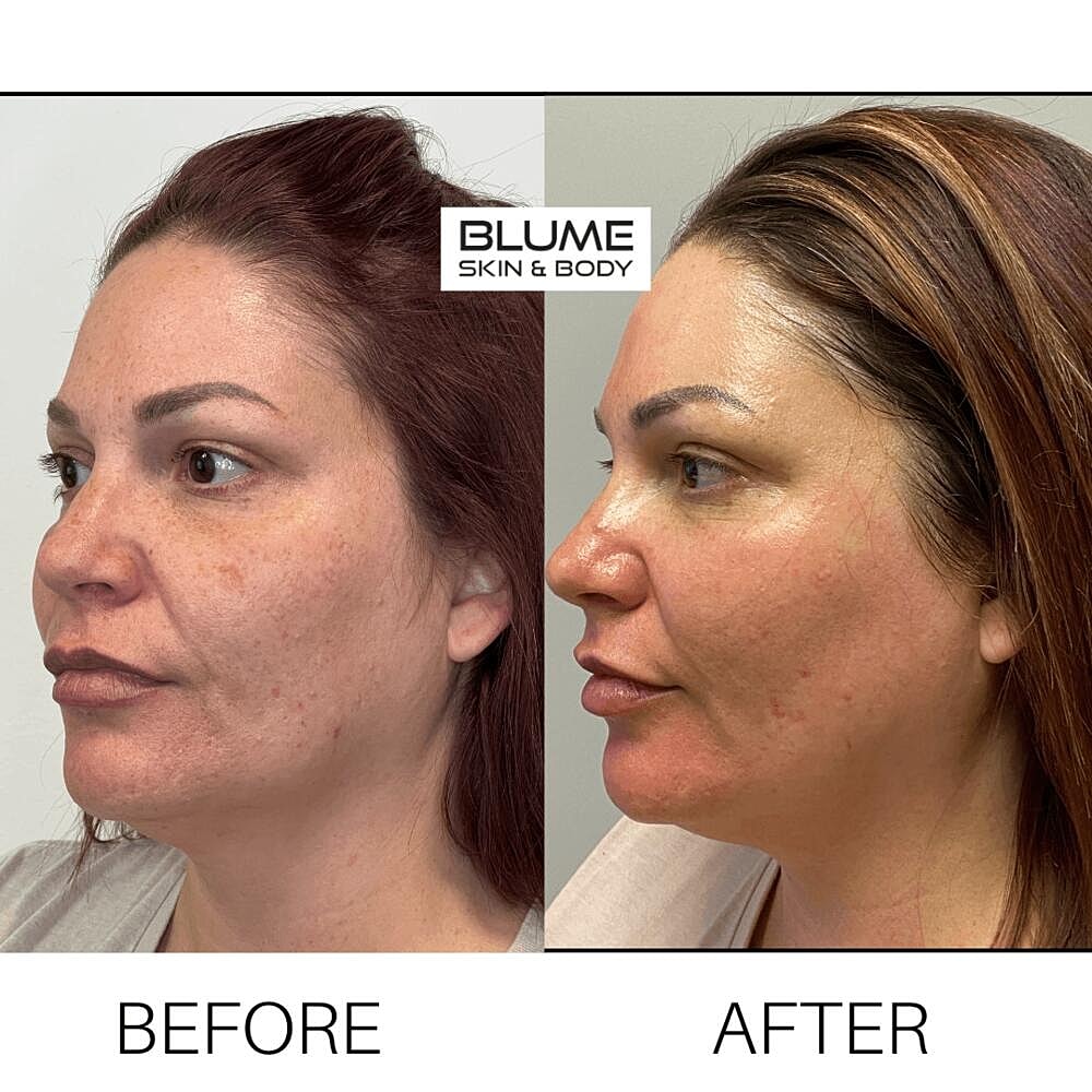 Laser Skin Treatments Before & After