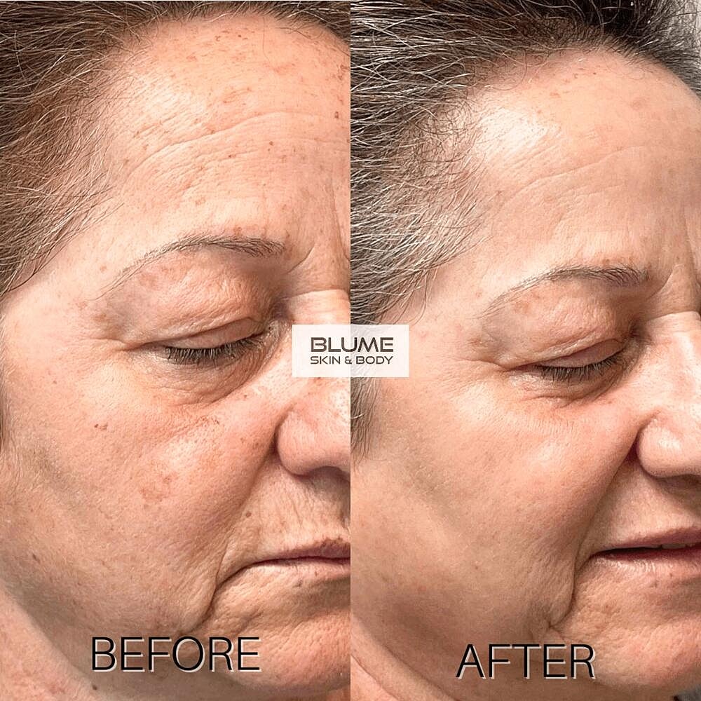 Laser Skin Treatments Before & After
