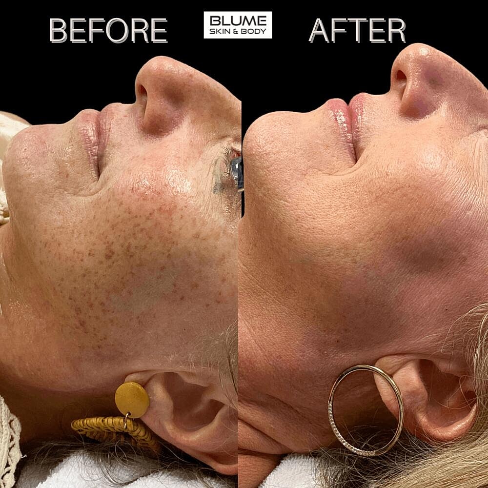 Laser Skin Treatments Before & After