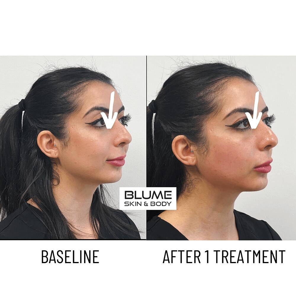 Laser Skin Treatments Before & After