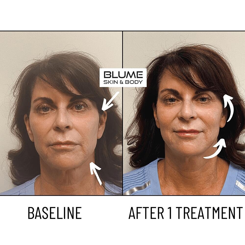 Laser Skin Treatments Before & After