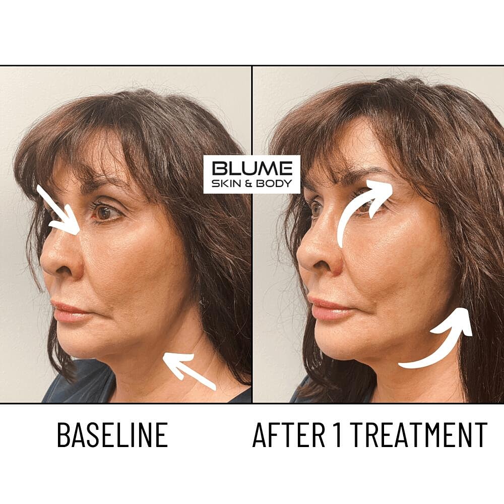 Laser Skin Treatments Before & After