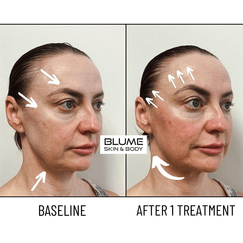 Laser Skin Treatments Before & After