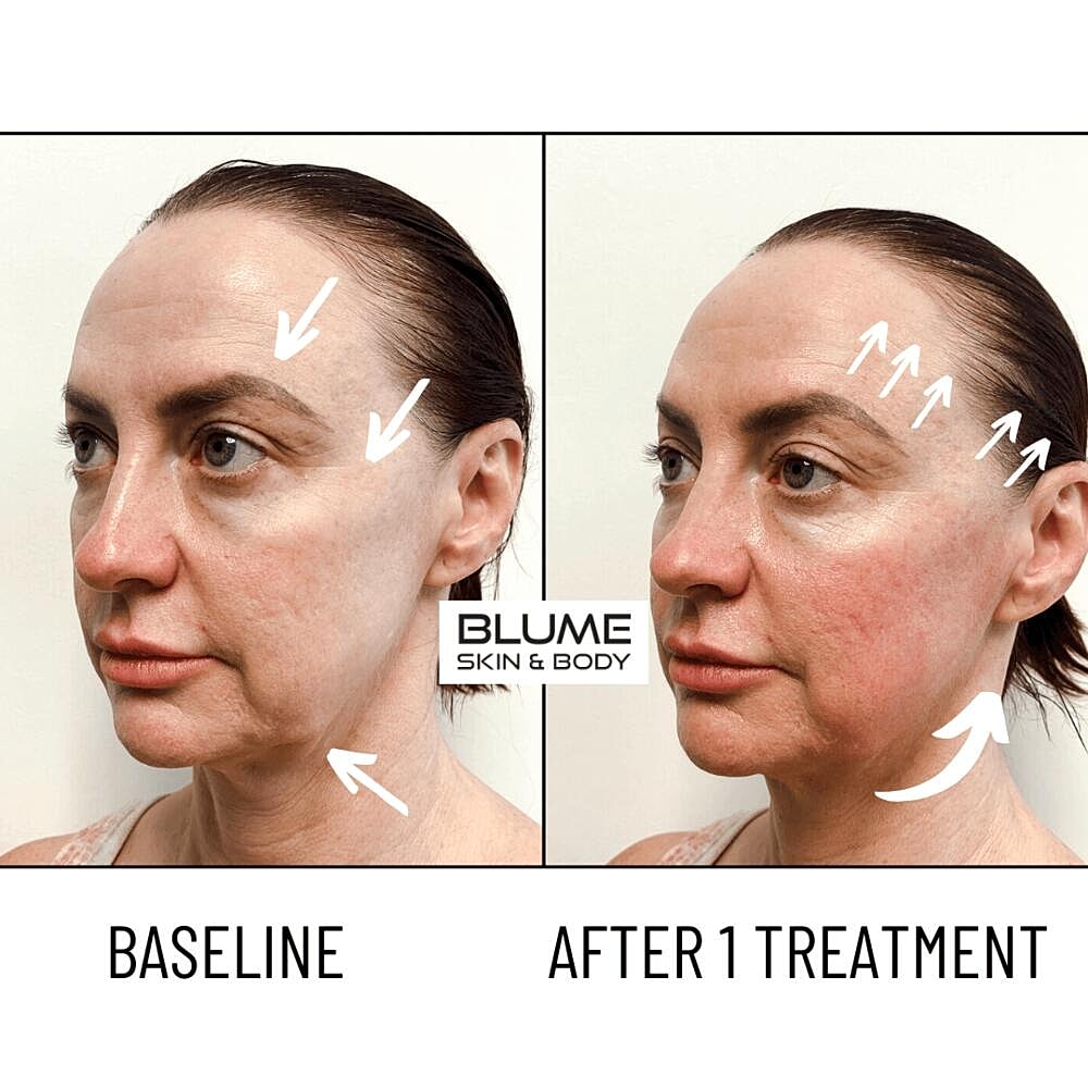 Laser Skin Treatments Before & After