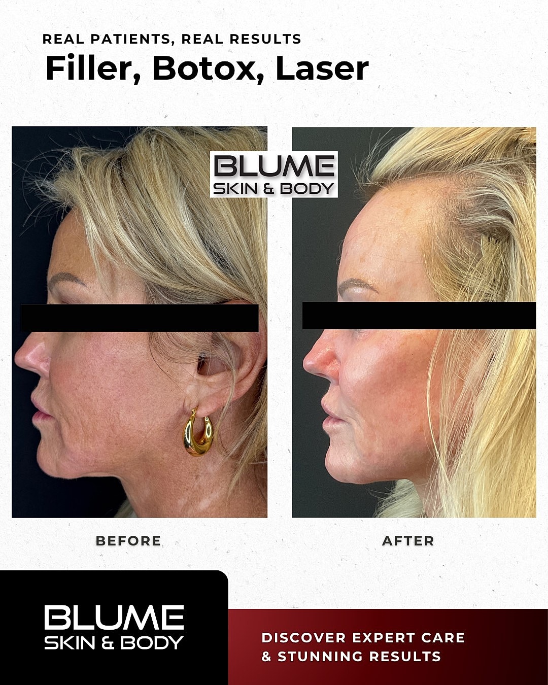Before and after cosmetic treatment comparison.
