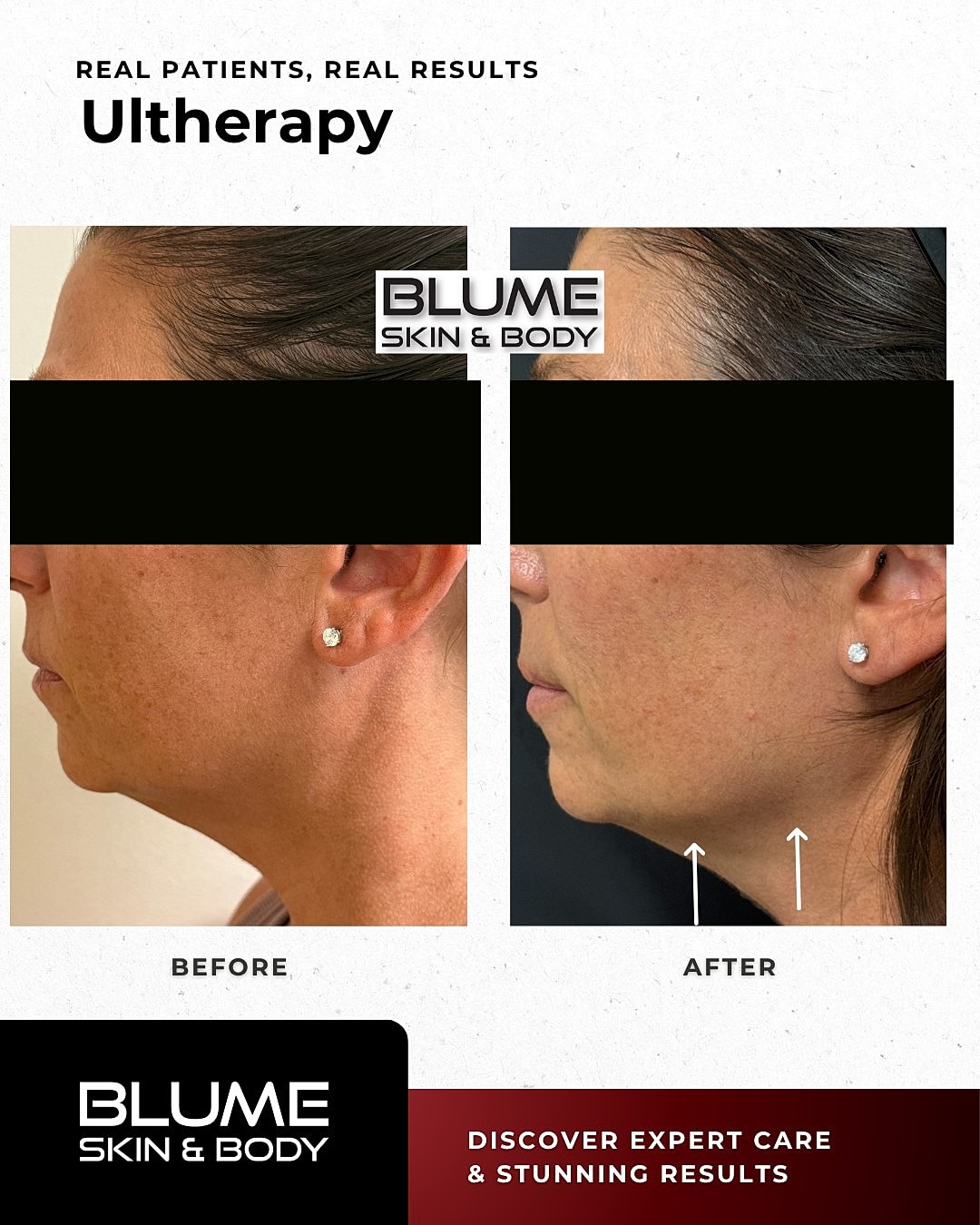 Ultherapy treatment results comparison before and after