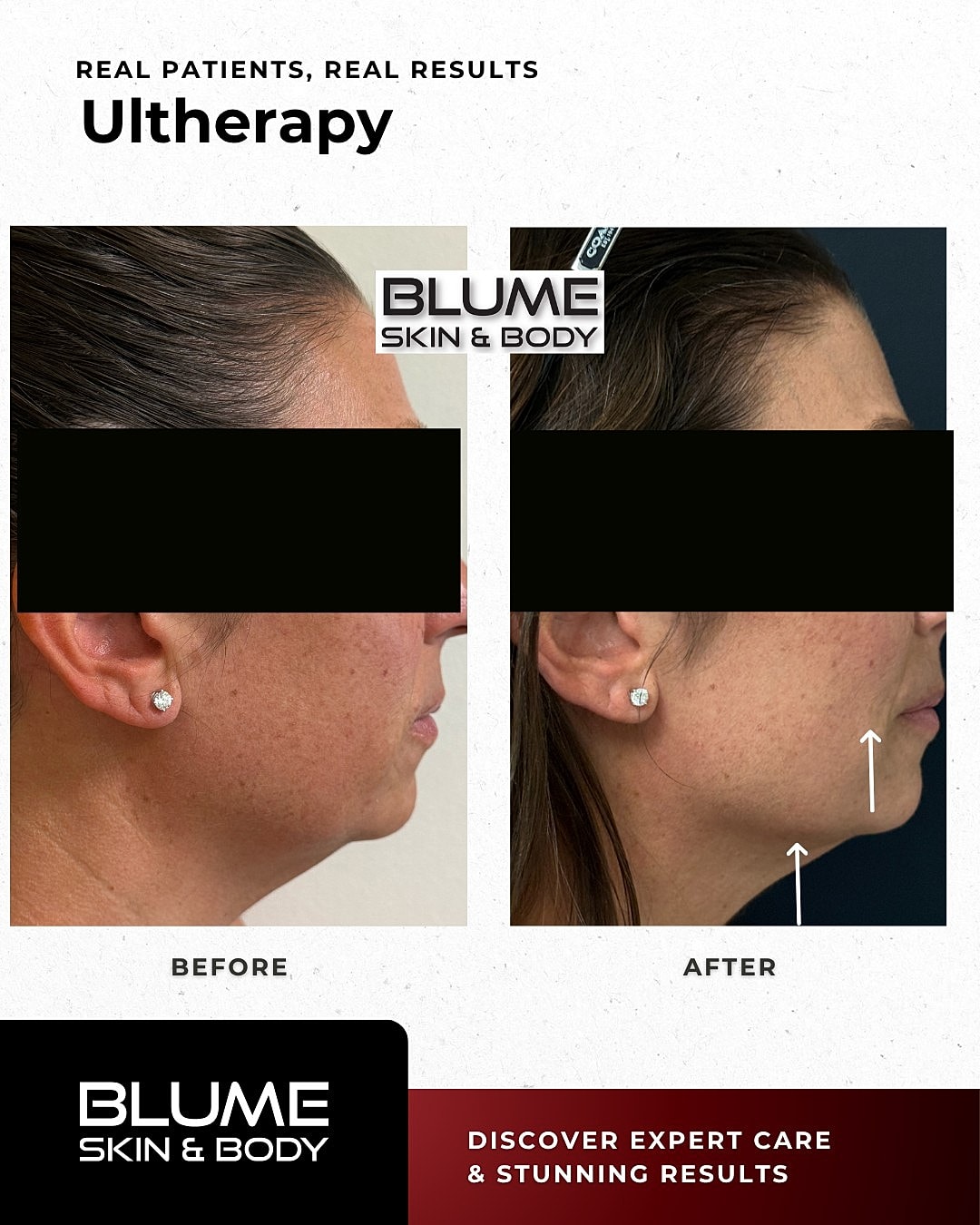 Ultherapy before and after comparison image