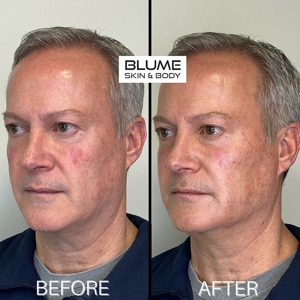 Botox Before & After