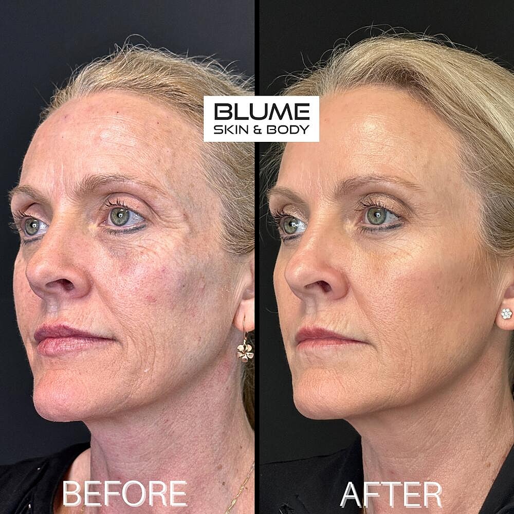 Botox Before & After