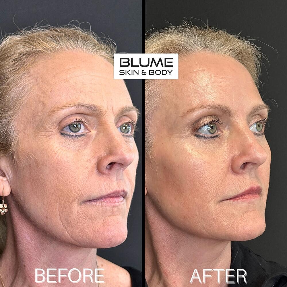 Botox Before & After