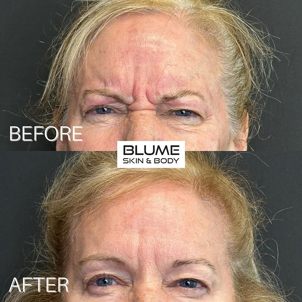 Botox Before & After