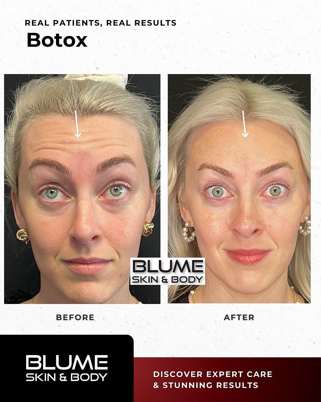 Botox Before & After
