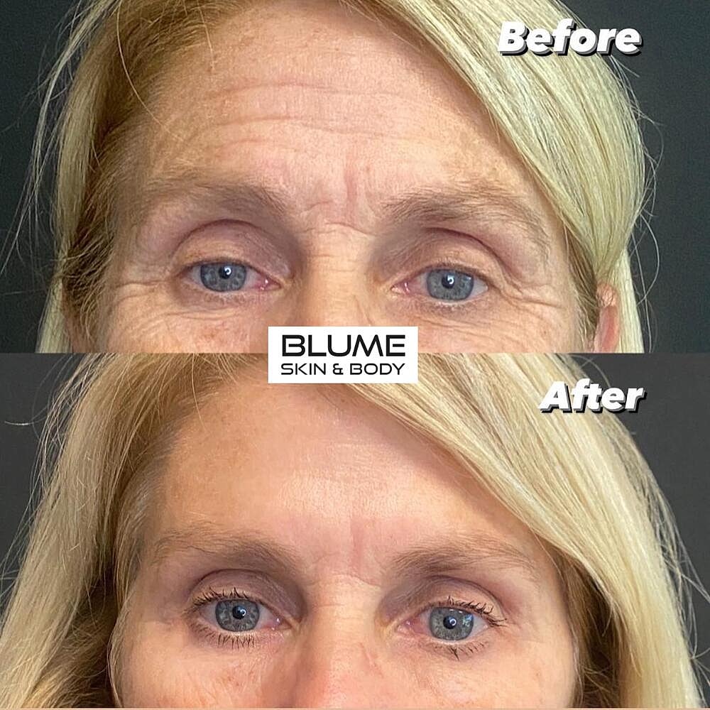 Botox Before & After