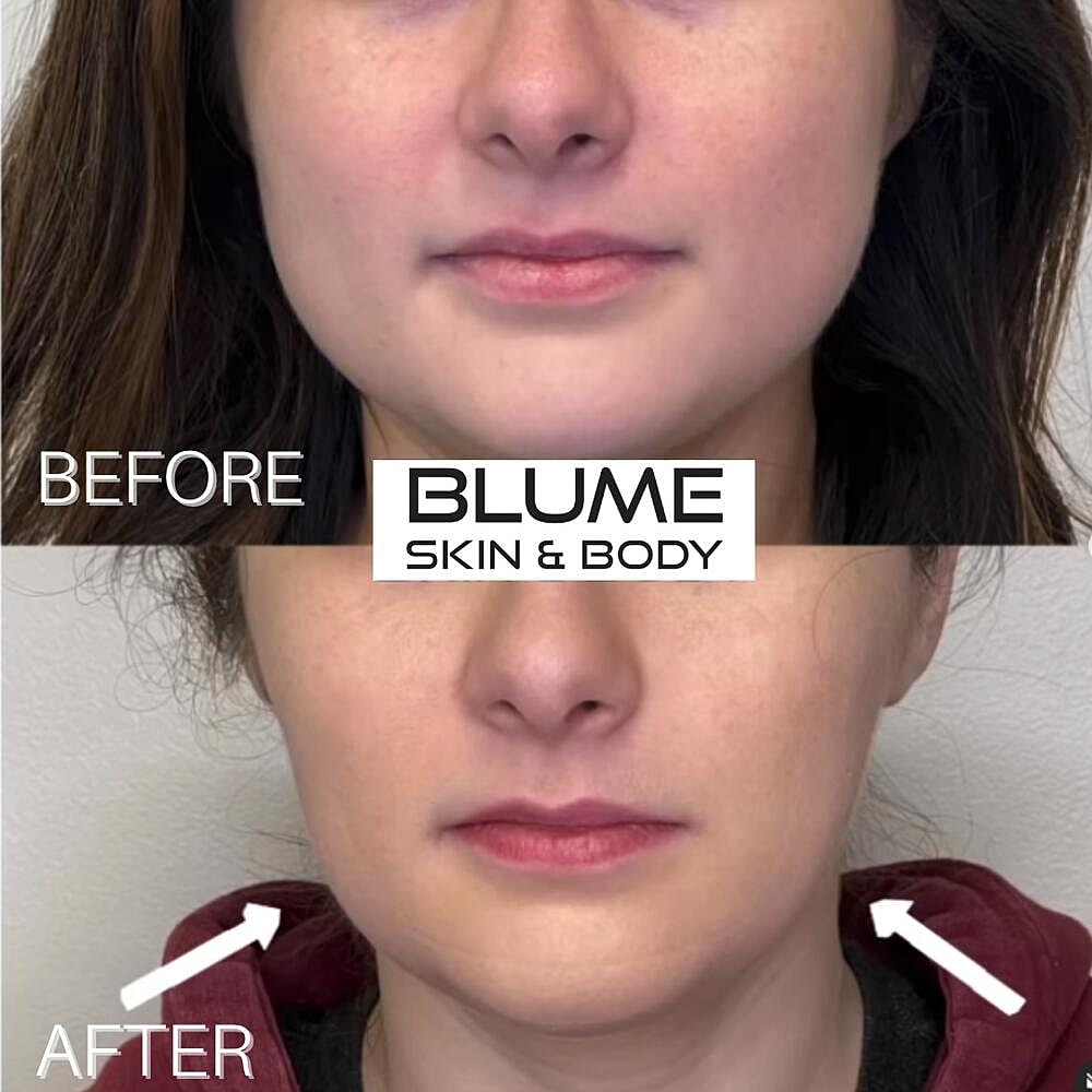 Botox Before & After