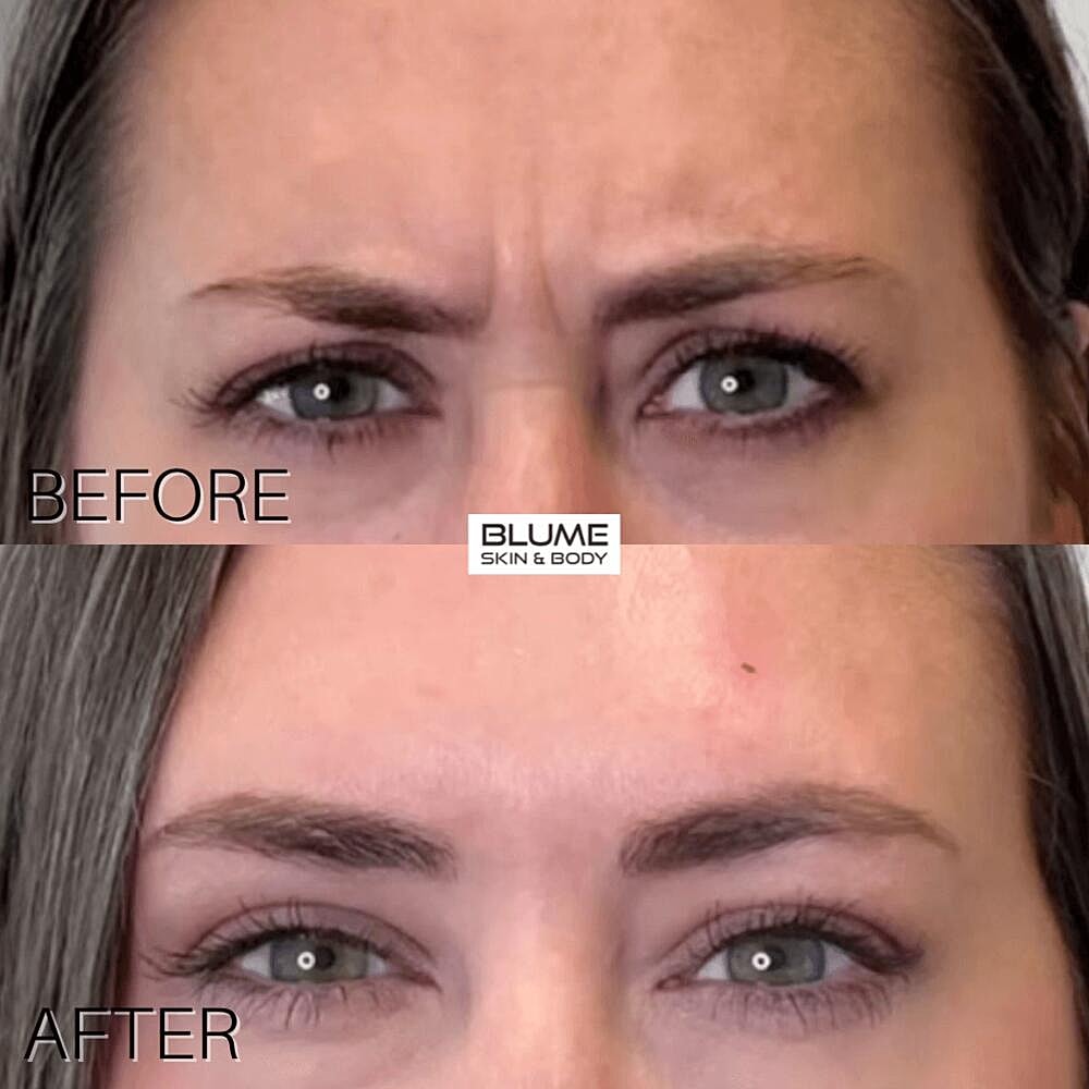 Botox Before & After