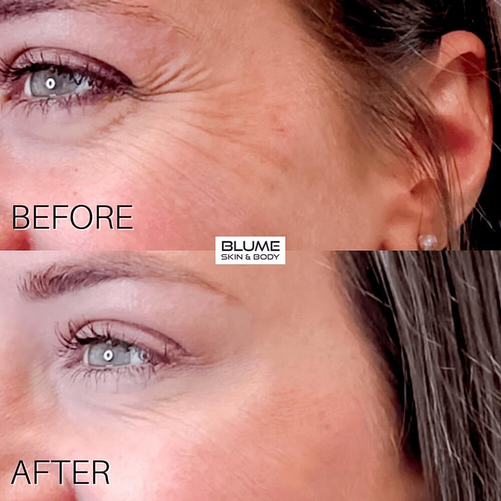 Botox Before & After