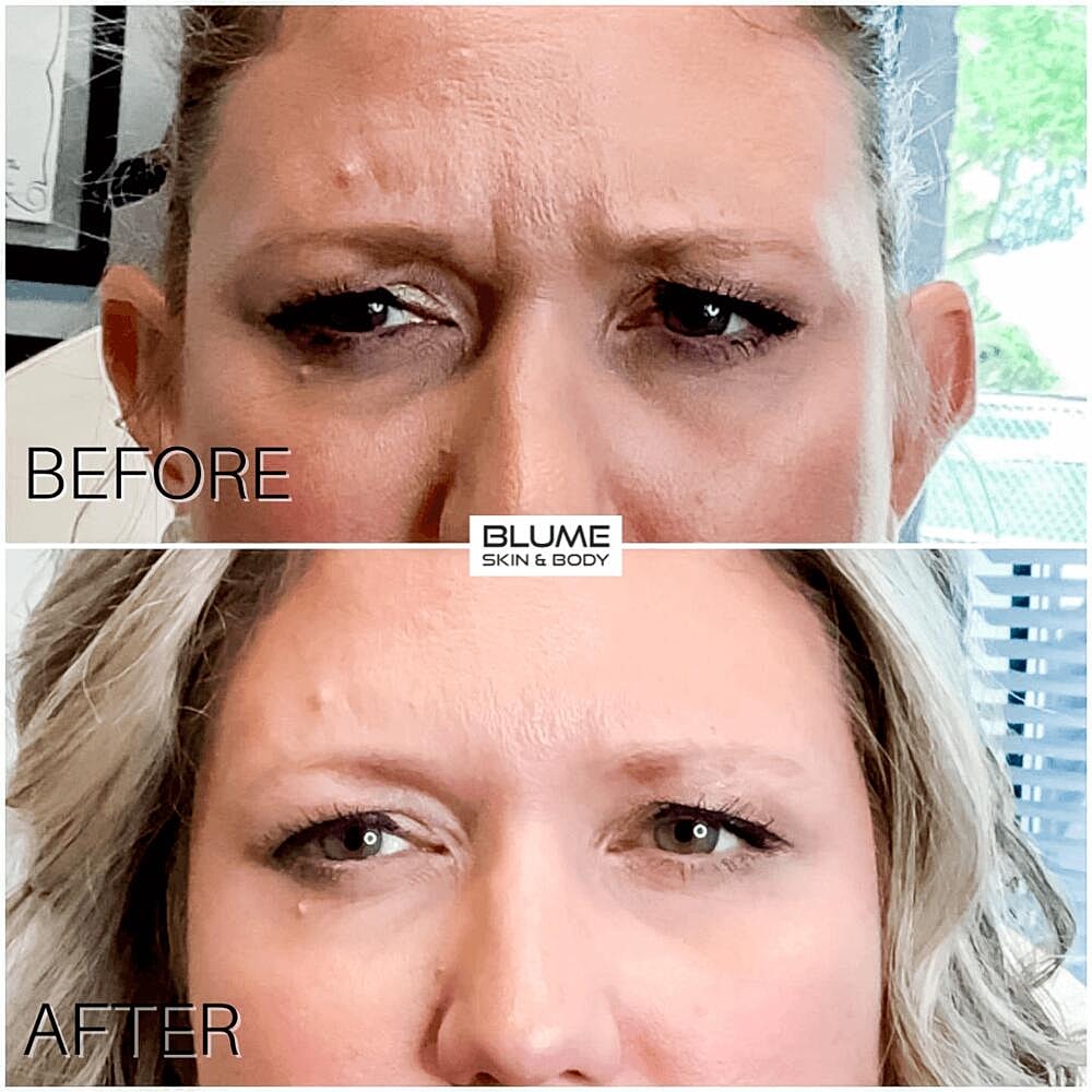 Botox Before & After