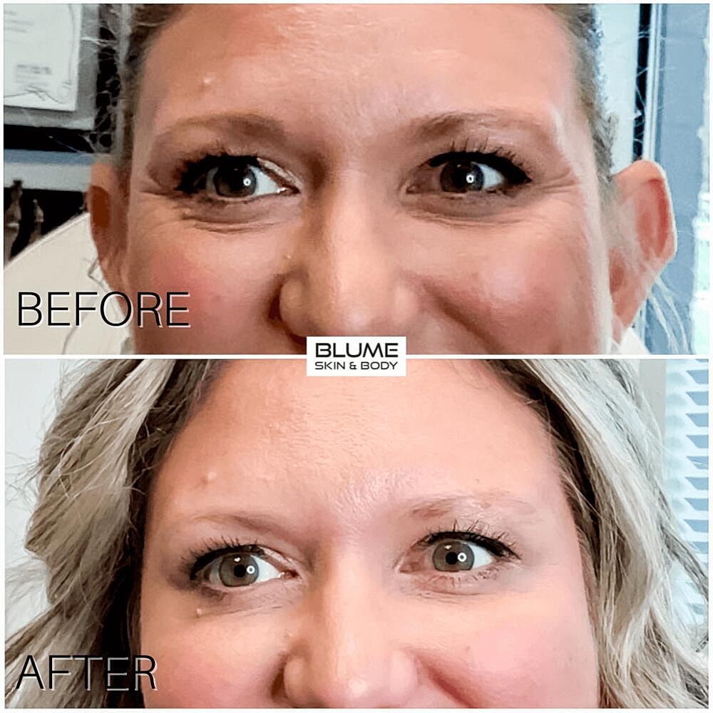 Botox Before & After