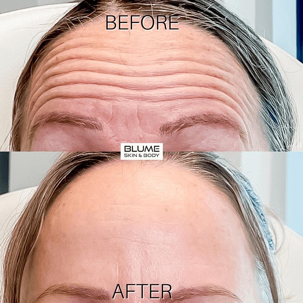 Botox Before & After