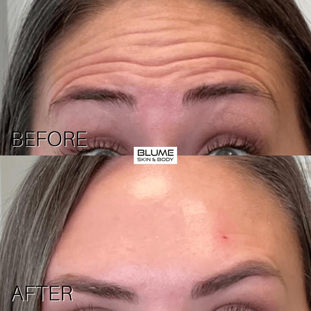 Botox Before & After