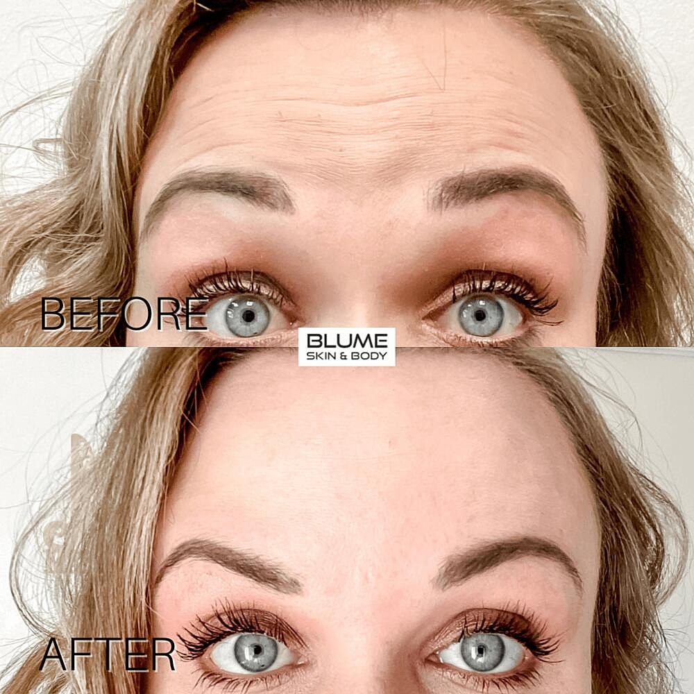 Botox Before & After