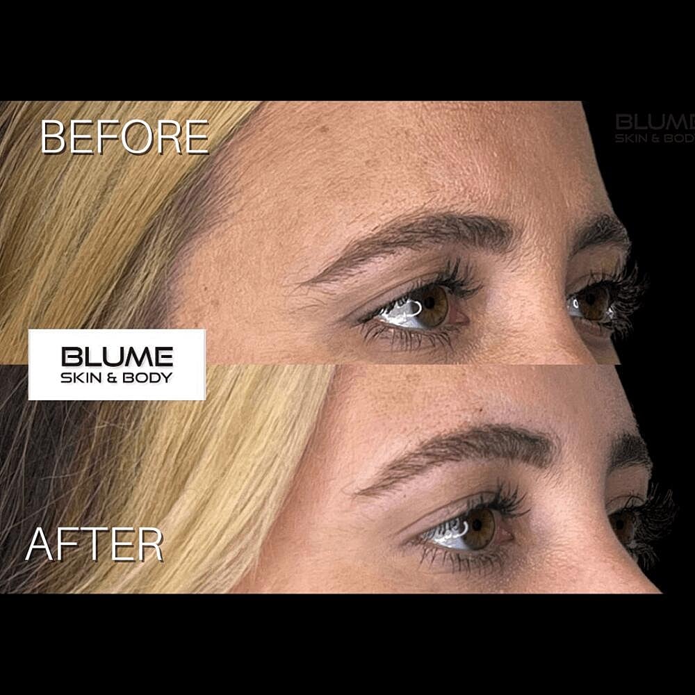 Botox Before & After