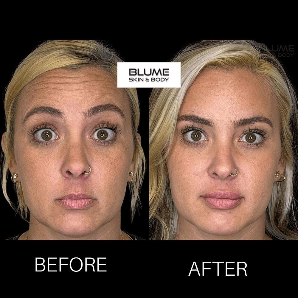 Botox Before & After