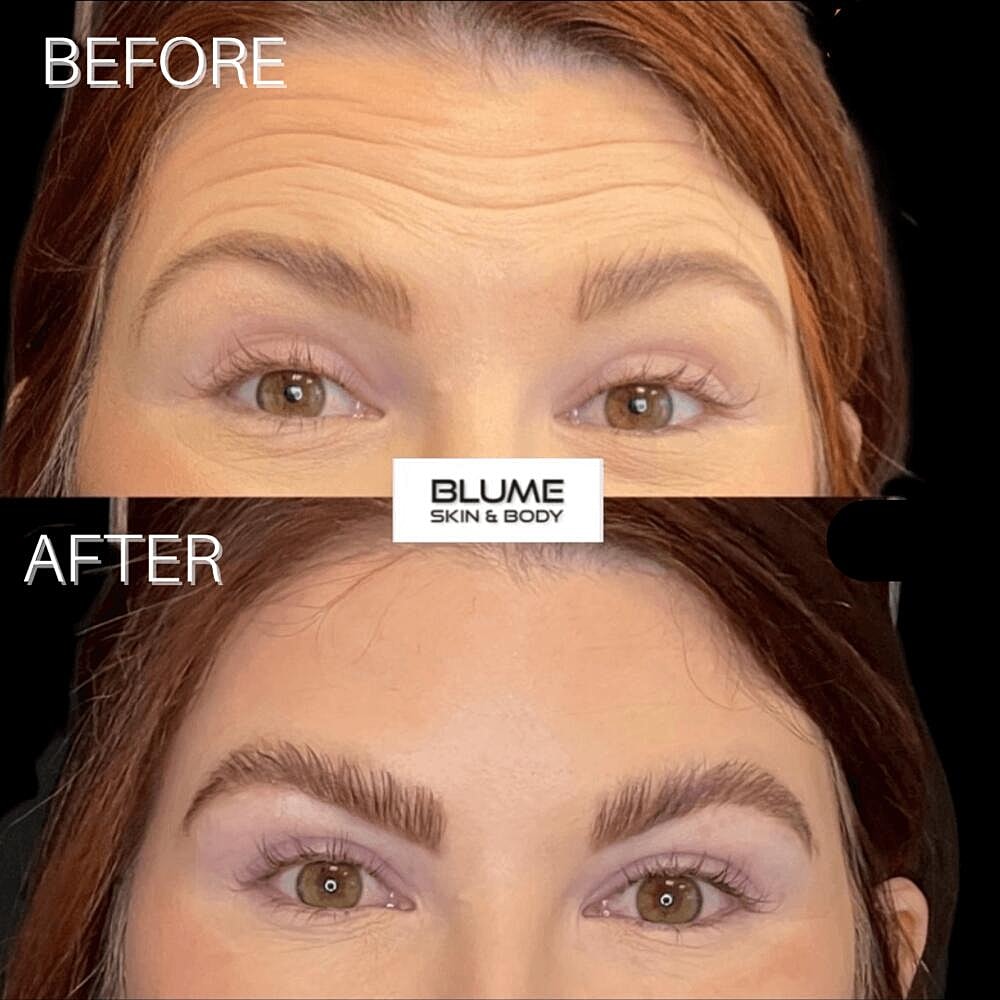 Botox Before & After