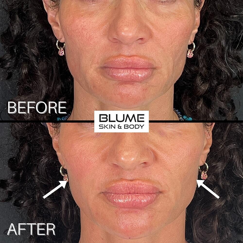 Dermal Fillers Before & After
