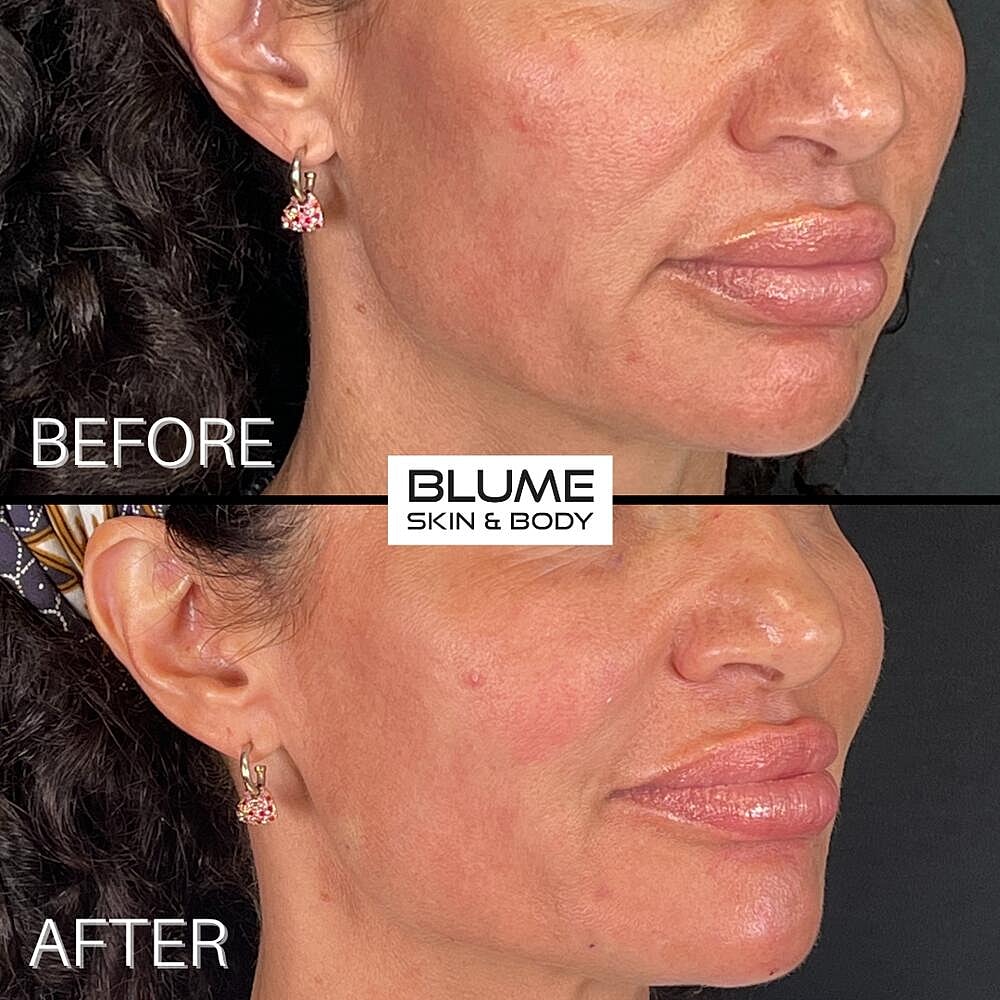Dermal Fillers Before & After