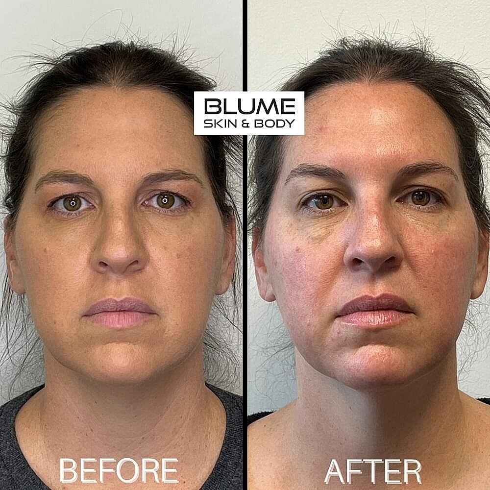 Dermal Fillers Before & After