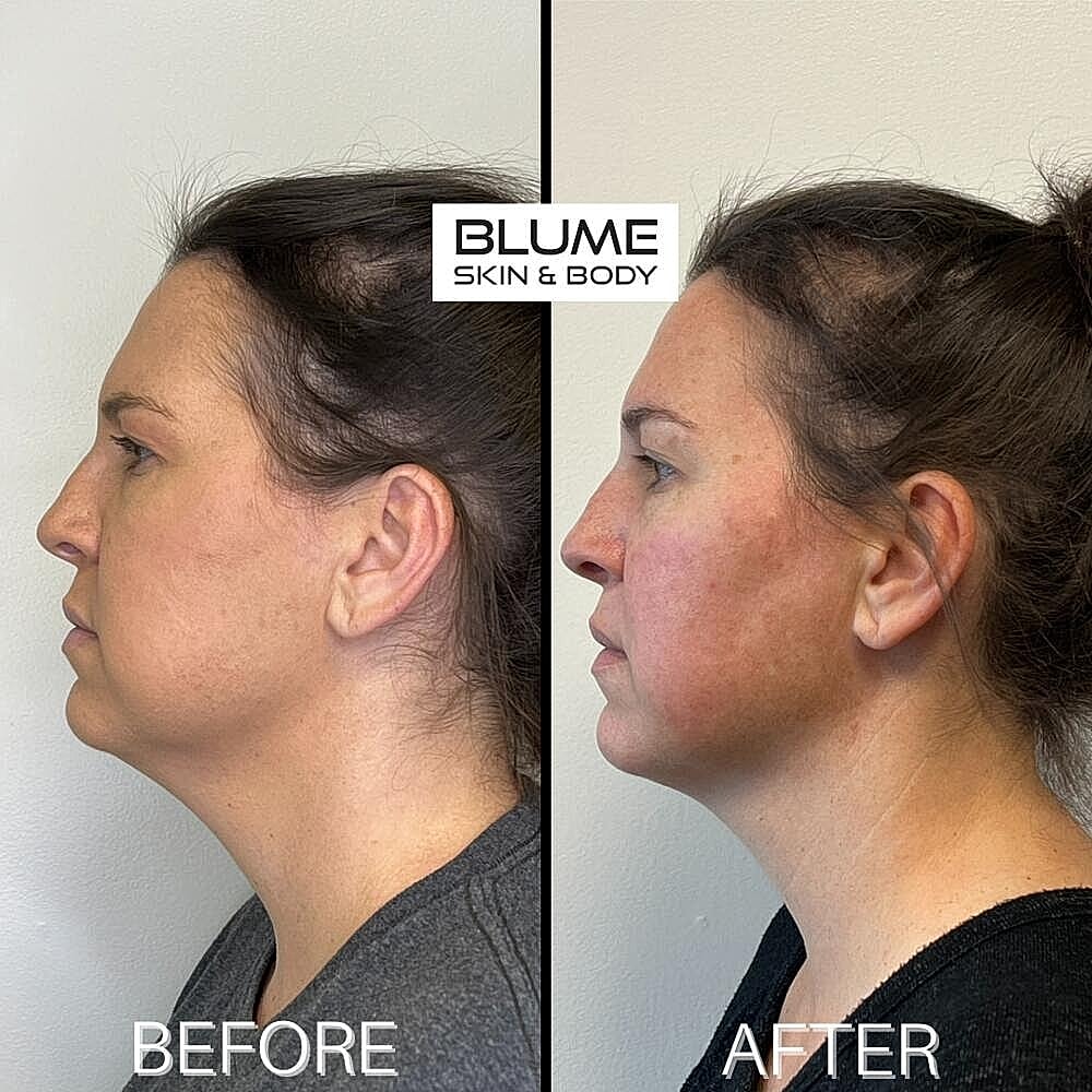 Dermal Fillers Before & After