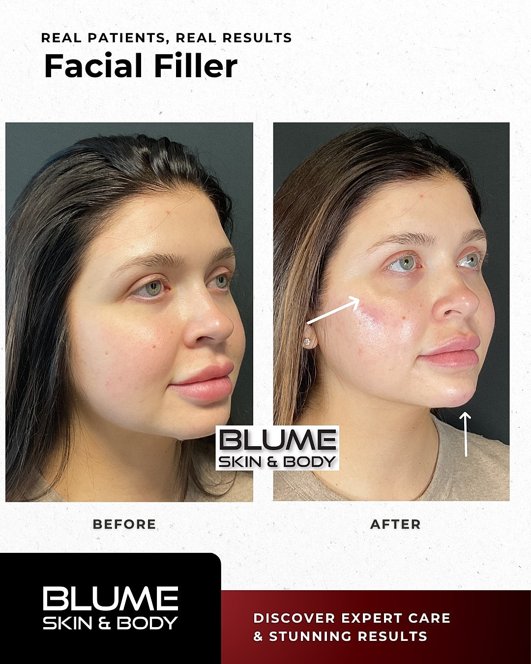 Before and after facial filler treatment results.