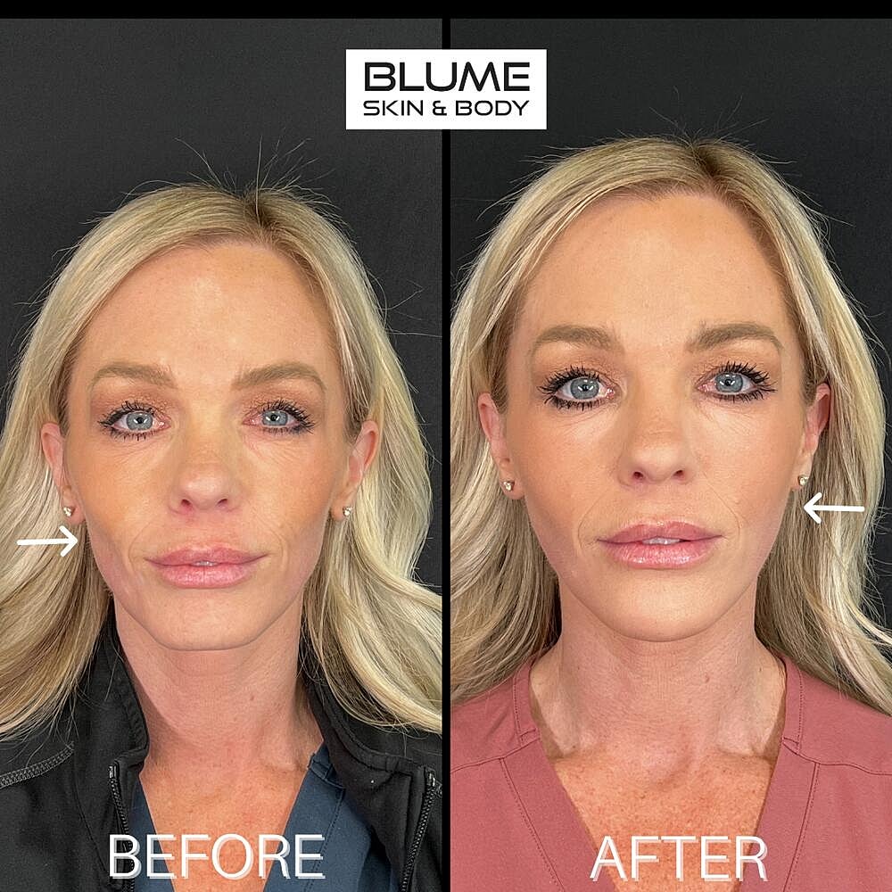Dermal Fillers Before & After
