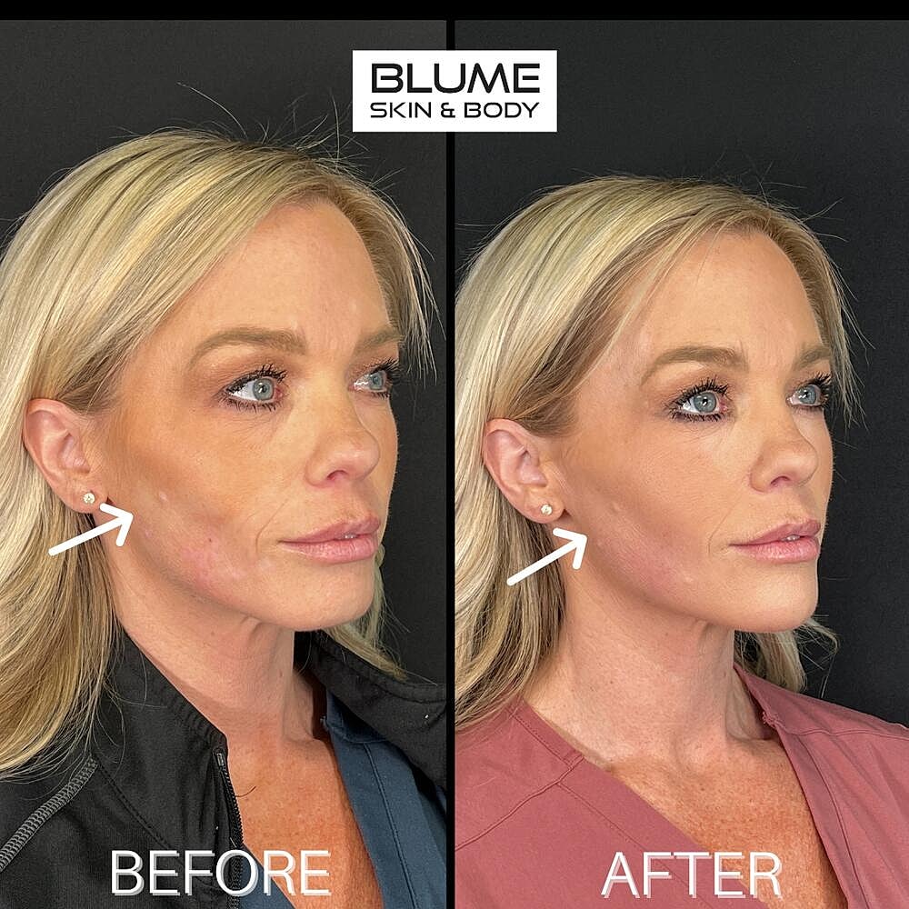 Dermal Fillers Before & After