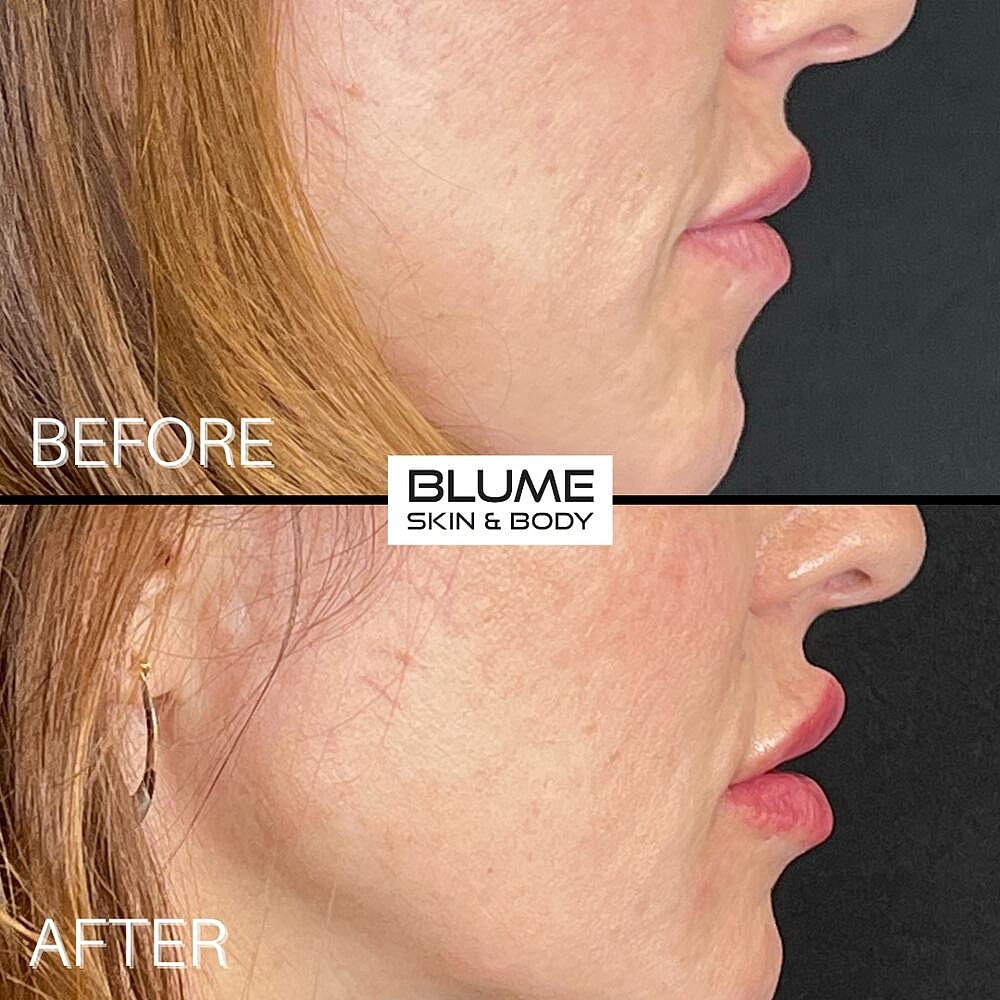 Dermal Fillers Before & After