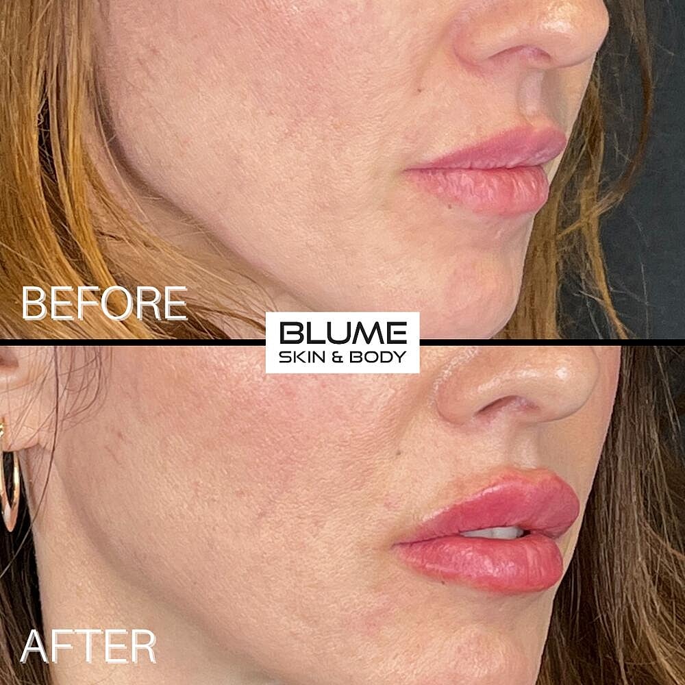 Dermal Fillers Before & After