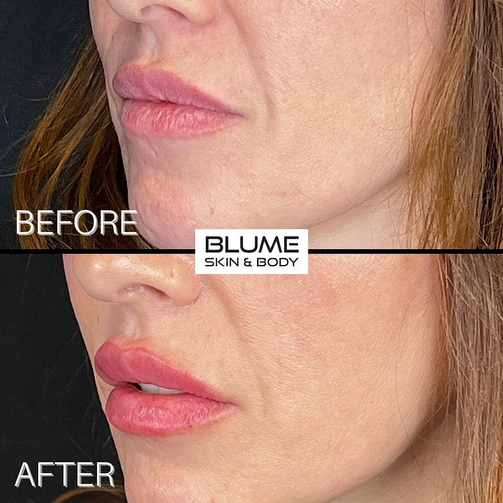 Dermal Fillers Before & After