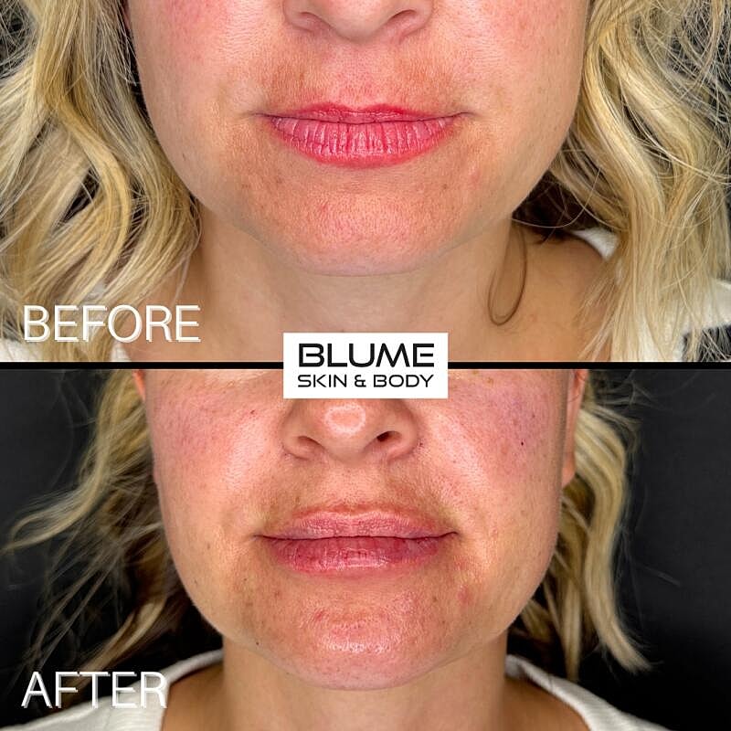 Dermal Fillers Before & After