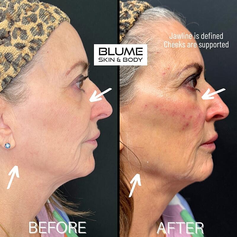 Dermal Fillers Before & After