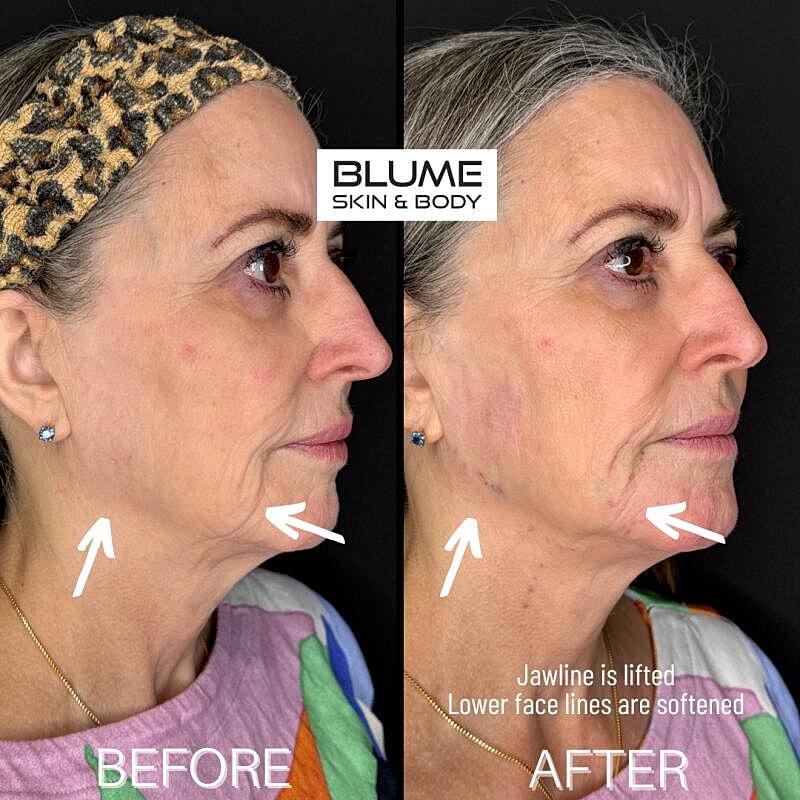 Dermal Fillers Before & After