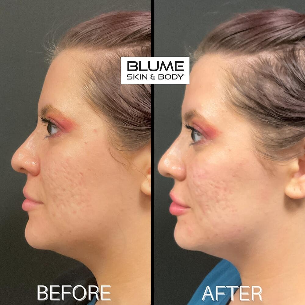 Dermal Fillers Before & After