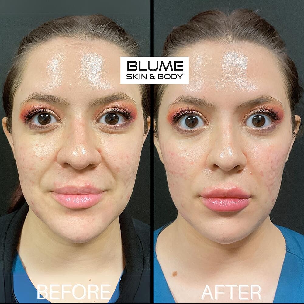 Dermal Fillers Before & After