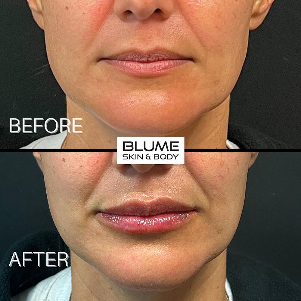 Dermal Fillers Before & After