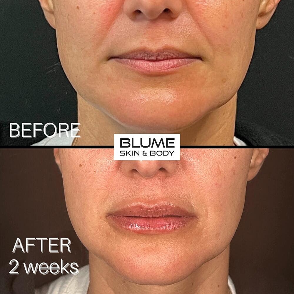 Dermal Fillers Before & After