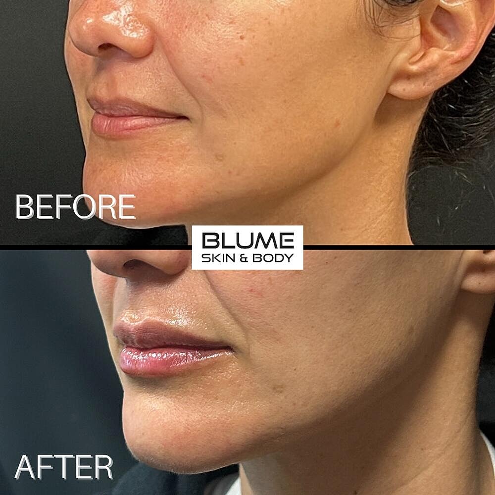 Dermal Fillers Before & After