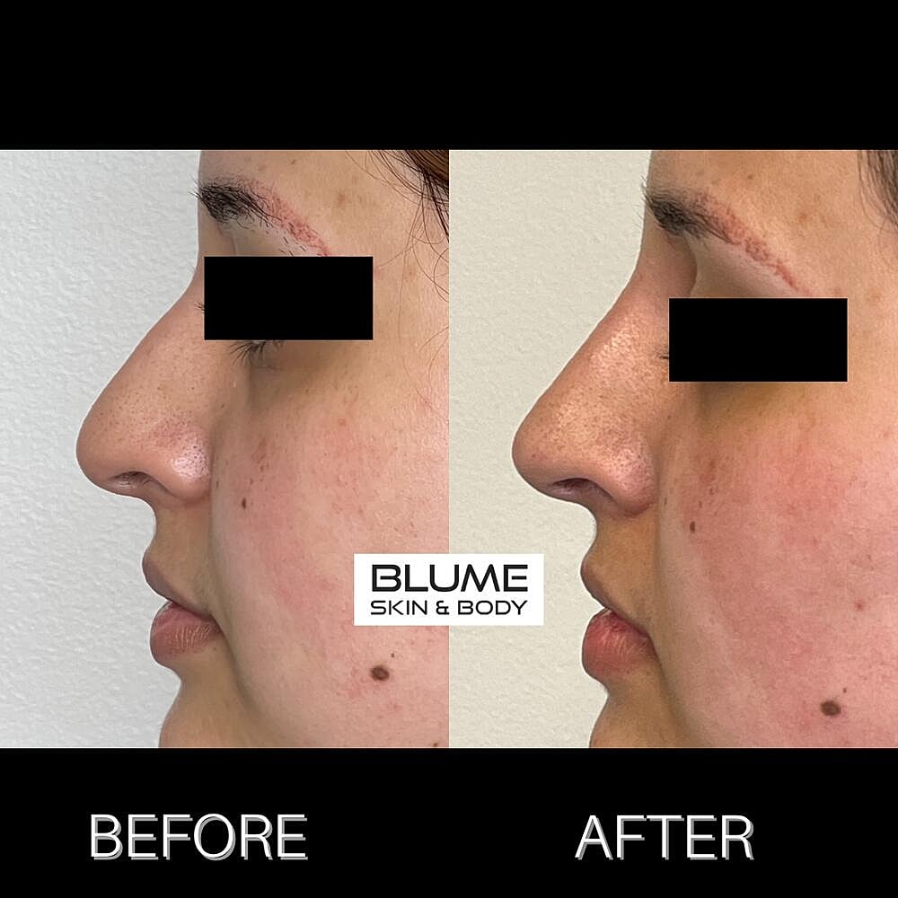 Dermal Fillers Before & After